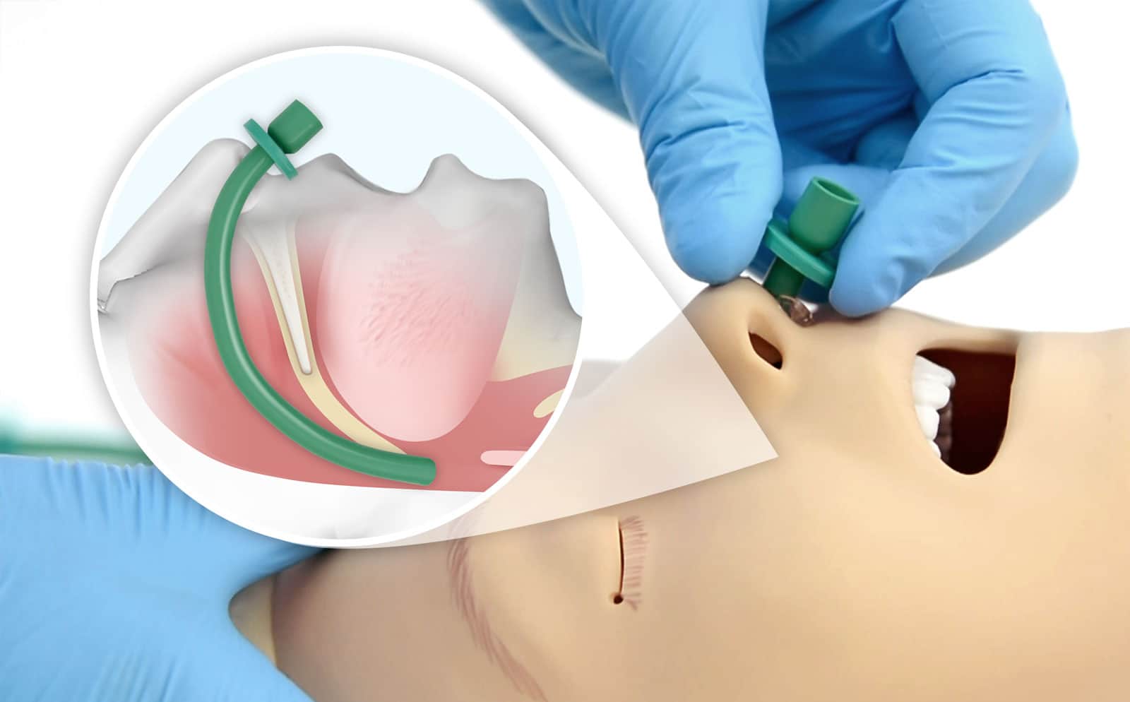 Nasopharyngeal Airway inbrengen