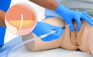 Eenmalige blaaskatheterisatie vrouw no touchtechniek