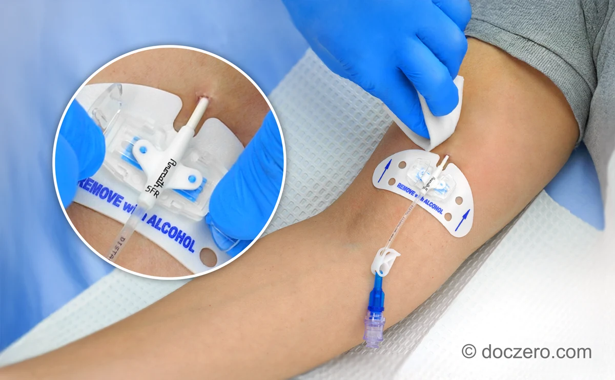 Verzorging perifeer ingebrachte centrale veneuze katheter (PICC)