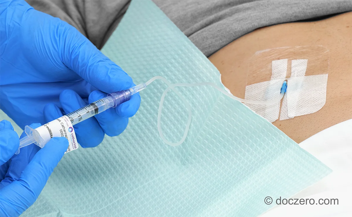 Medicatie toedienen met bolusinjectie via een subcutaan infuus