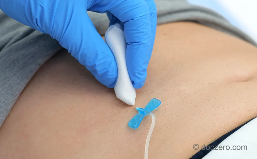 Verzorging subcutaan infuus