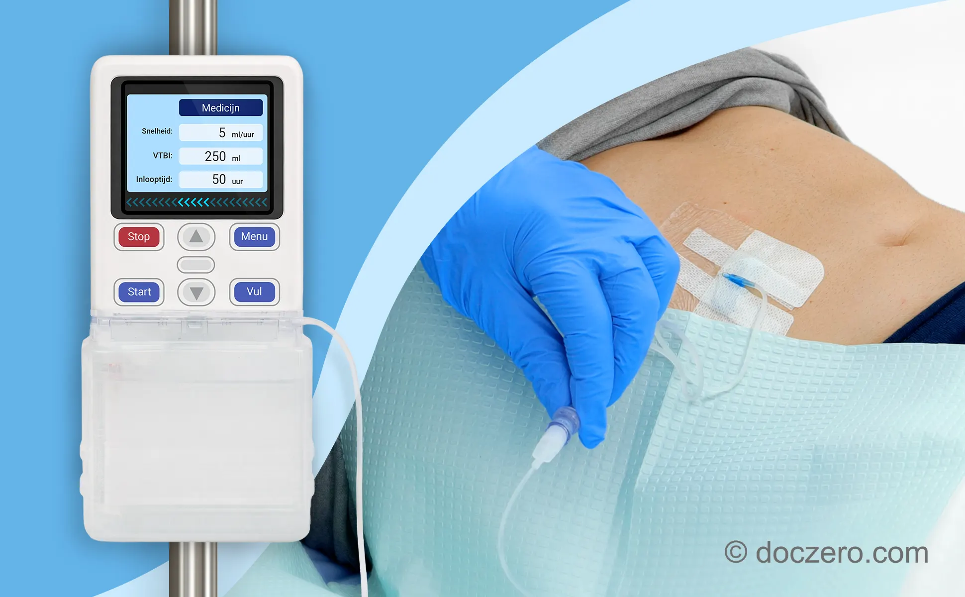 Medicatie toedienen met cassettepomp via een subcutaan infuus