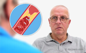 Beroerte CVA TIA | Doczero